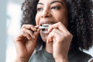 clear aligners